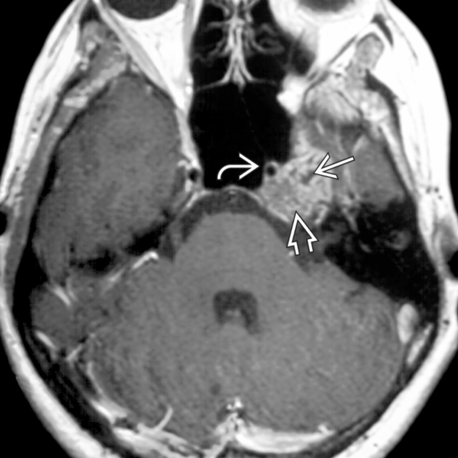 Axial T1 C+ MR shows mottled enhancement
within a chondrosarcoma centered at the left petrooccipital fissure. Calcified matrix is seen as a focal low signal intensity area
within the otherwise enhancing tumor. The left internal carotid artery is patent
.