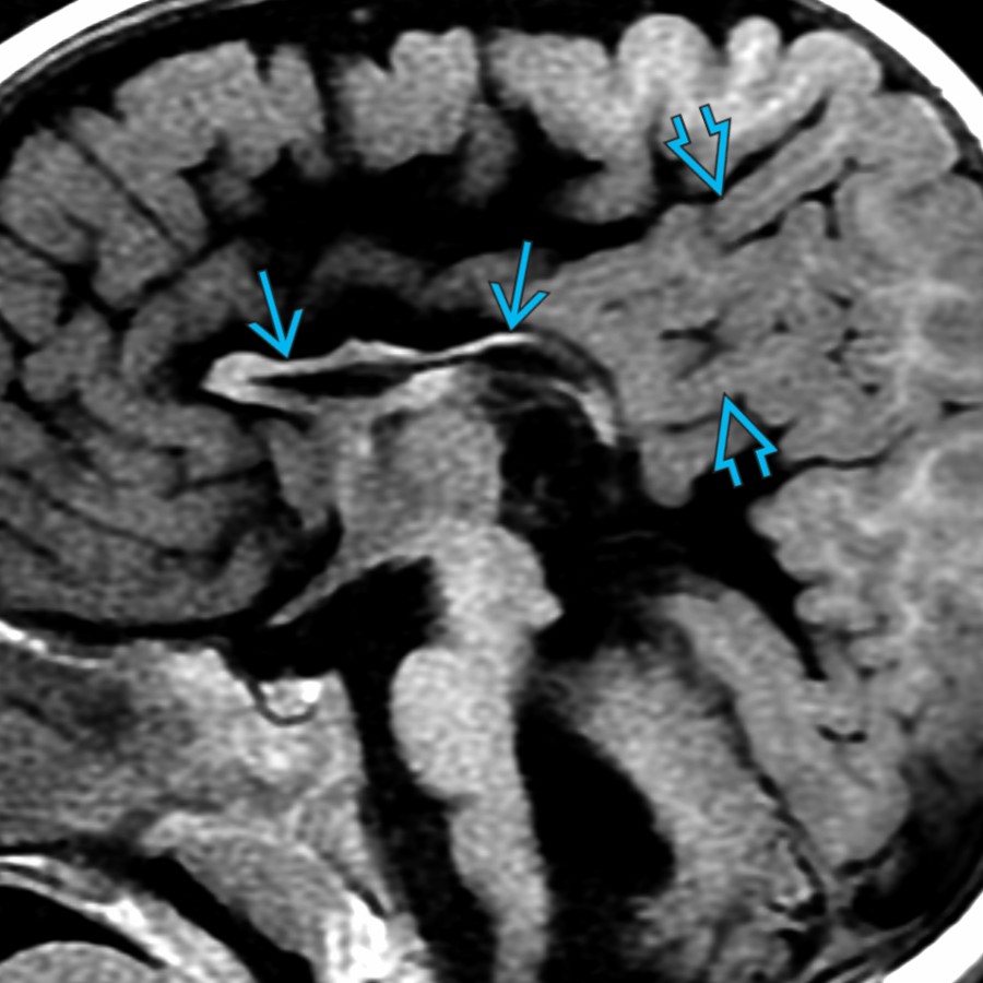 Midline sagittal T1 MR in the same patient 1 year after shunting shows a thinned & dysmorphic CC
as well as numerous thin, pencil-like gyri (stenogyria)
.