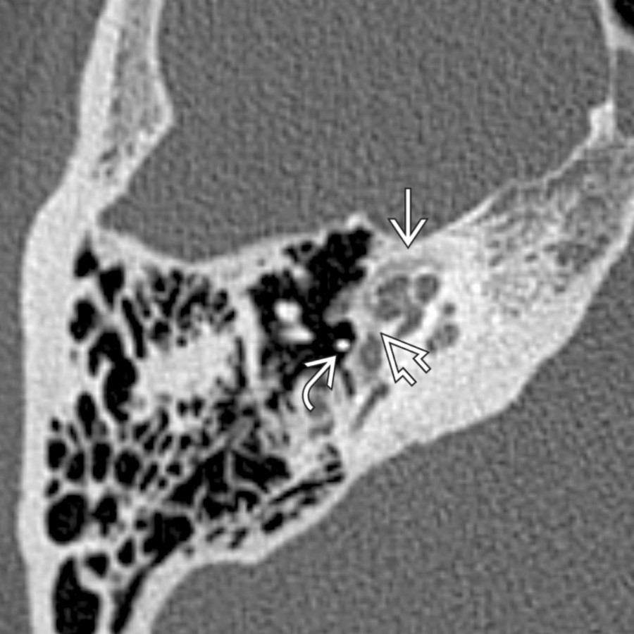 Axial bone CT shows cochlear otosclerosis yielding SNHL. Note confluent otic capsule lucency
adjacent to the cochlea. Patients commonly have fenestral involvement with lucency near the fissula ante fenestram
, contributing a conductive component to hearing loss. Note the prior partial ossicular replacement prosthesis
.