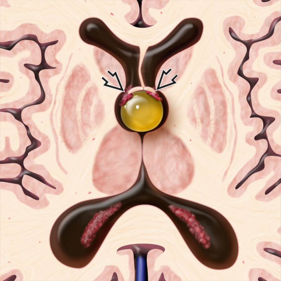 Axial graphic shows a classic colloid cyst (CC) at the foramen of Monro causing mild/moderate obstructive hydrocephalus. Note that the fornices and choroid plexus are elevated and stretched over the cyst
.