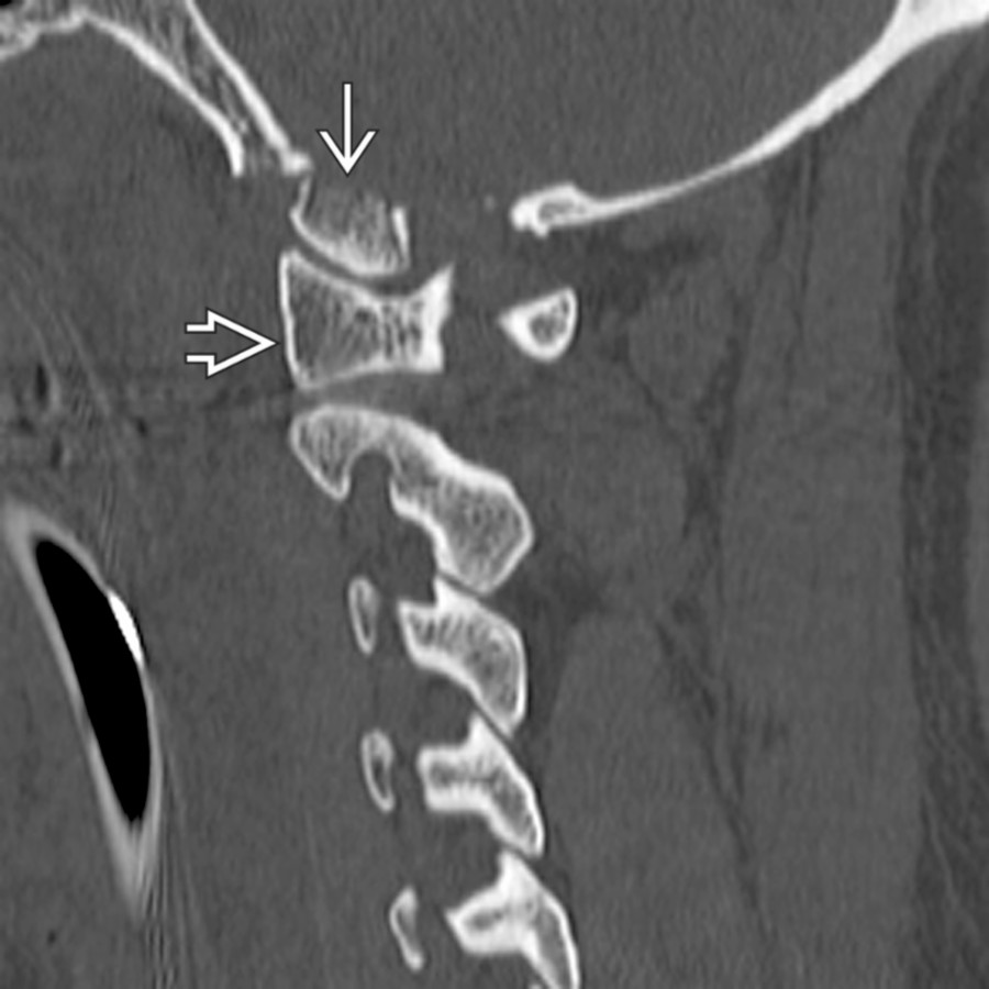 Parasagittal CT shows a condyle fracture
that has maintained its relationship with the lateral mass of C1
despite the posterior displacement.