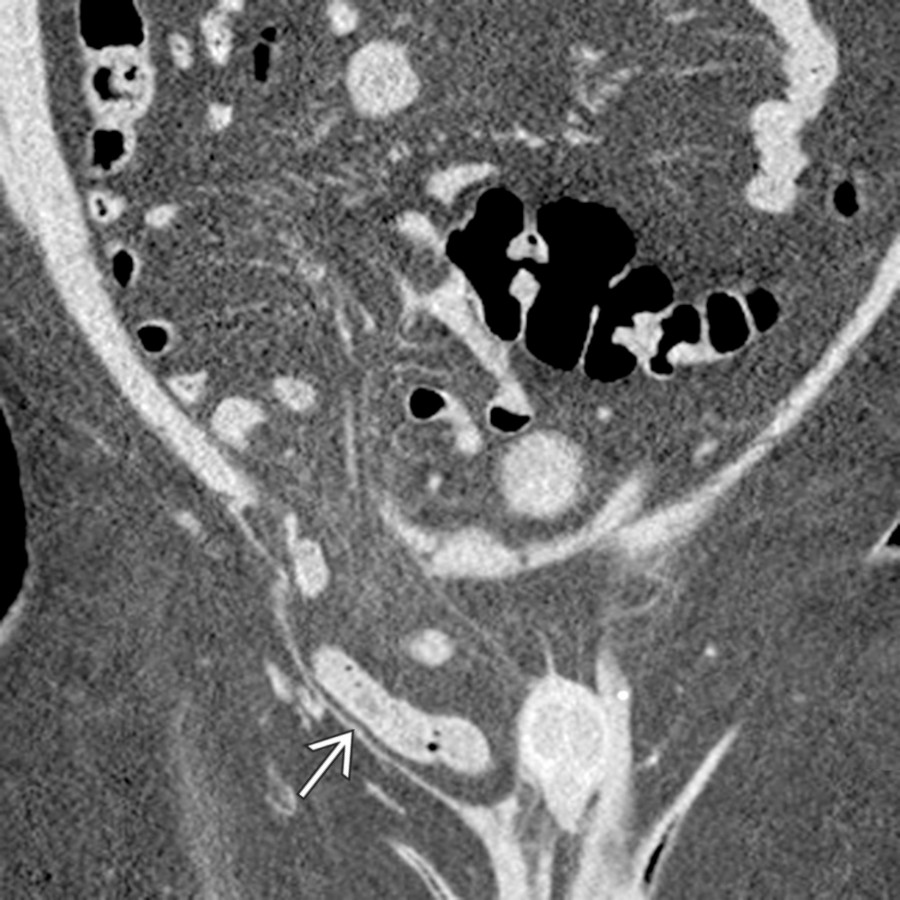 Coronal NECT demonstrates the typical appearance of an inguinal hernia in the coronal plane with involvement of small bowel loops
.