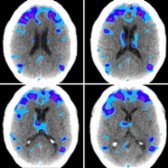 Axial fused F-18 FDG PET/CTs in the same patient show predominantly frontal hypometabolism in purple/blue areas
, signifying regions with a z-score > -2, or 2 standard deviations less than expected in normal controls.