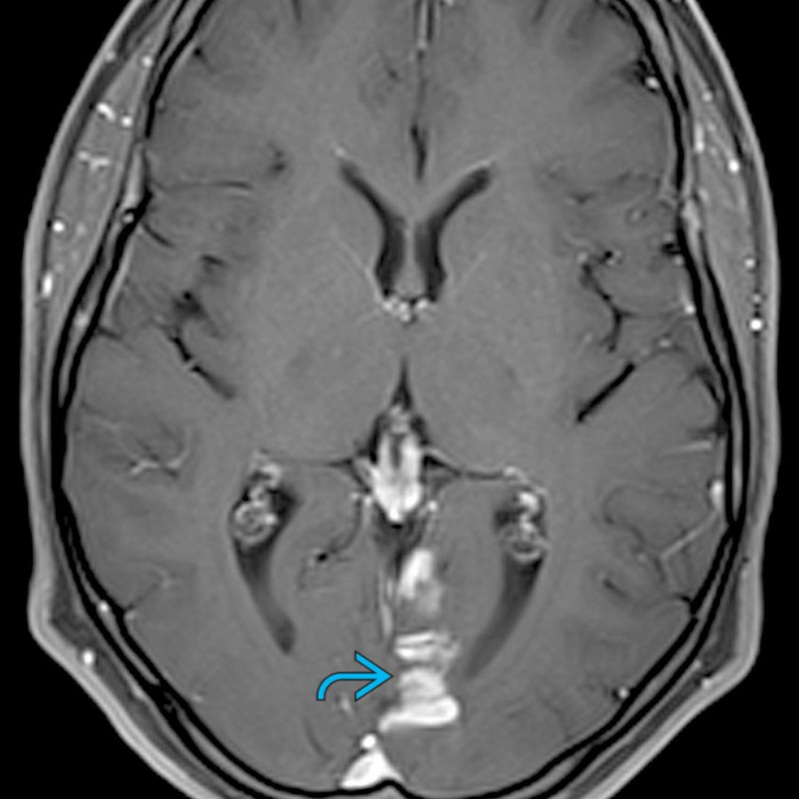 Axial T1 C+ MR shows well-defined gyriform enhancement
in the PCA distribution in a subacute infarct patient who was sent to a neurosurgeon for concerns of a cortical "tumor."