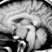 Sagittal T1WI MR demonstrates a huge tuber cinereum hamartoma.