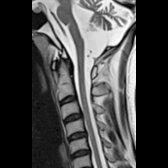 Sagittal T2WI MR in a SCA3/MJD patient shows atrophy of pontine tegmentum (dorsal pons) with a concave posterior pontine surface
. Also notice the severe atrophy of cerebellum
and superior cerebellar peduncle (SCP)
. There is atrophy of medulla
and upper cervical spinal cord
.