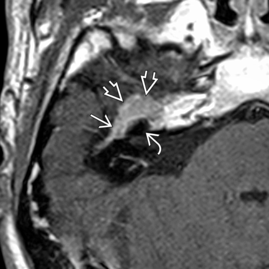 Axial T1 C+ MR in the same patient shows diffuse FNVM enhancement in the geniculate fossa
, arching around the cochlea
along the anteromedial temporal bone surface
.