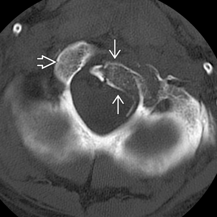 Axial CT shows a type 3 condyle fracture
rotated into the foramen magnum. Note the normal position of the right condyle
.