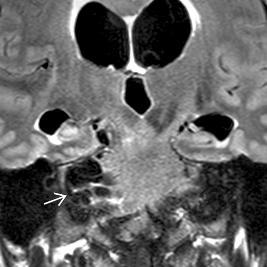 Coronal T1 C+ FS MR shows multiple cysts in the right CPA cistern
causing mass effect on the brainstem. Secondary hydrocephalus is present.
