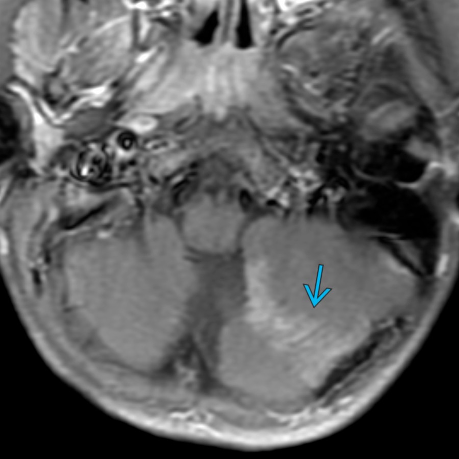 Axial T1 C+ MR in a 4-year-old boy shows a wedge-shaped, enhancing left cerebellar tuber
. The majority of cerebellar tubers enhance, in contrast to the supratentorial cerebral hemisphere tubers, which rarely enhance.