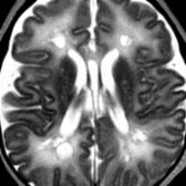 Axial T2 MR in an infant with congenital CMV infection shows multiple periventricular germinolytic cysts
.