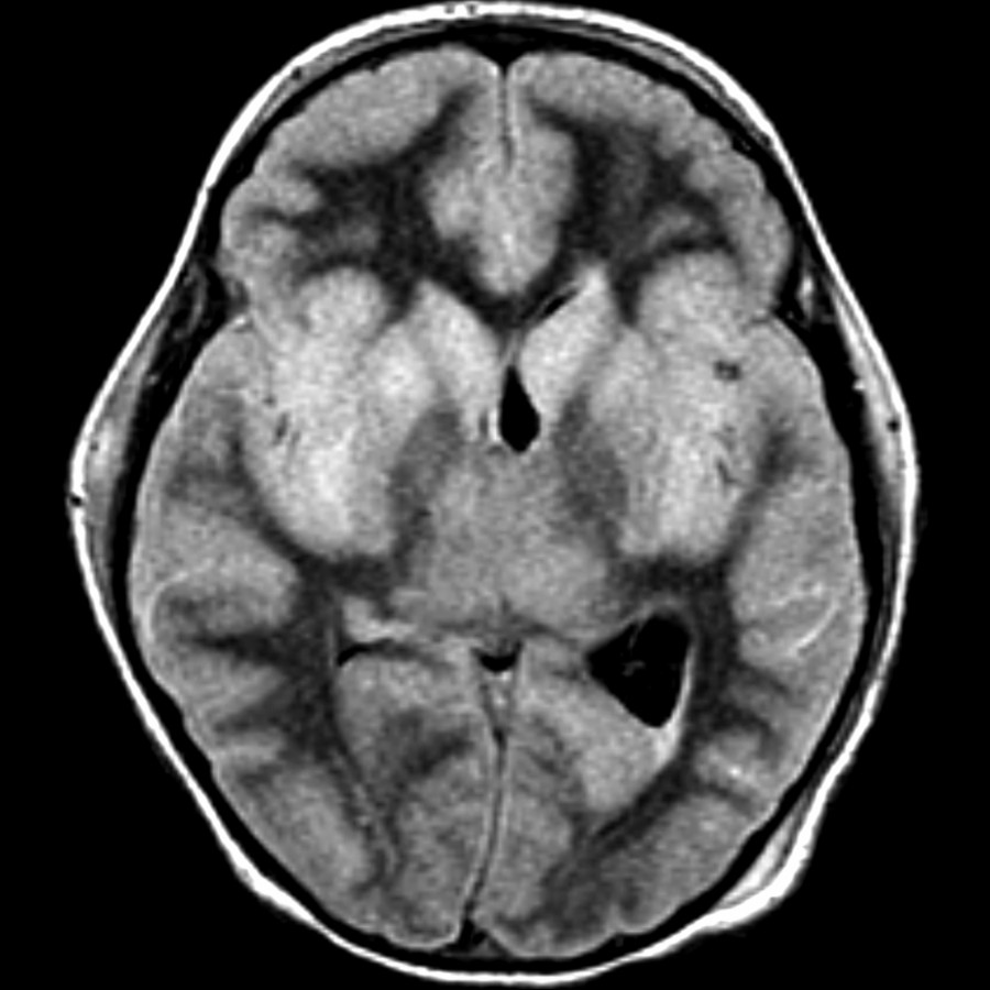 Axial FLAIR MR shows diffuse gray matter swelling and hyperintensity with resulting effacement of the cerebral sulci and right lateral ventricle. This patient eventually succumbed to rabies encephalitis.