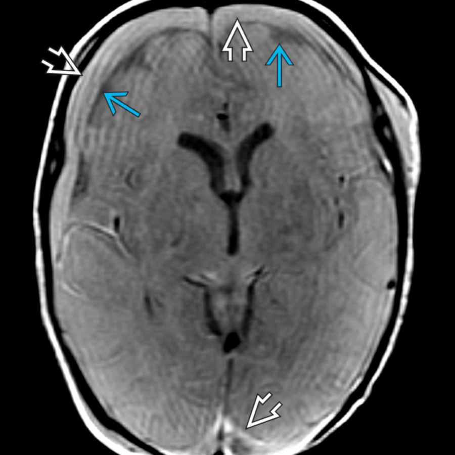 Axial PD MR shows bilateral SDHs
after a shaking injury. Note how this sequence clearly differentiates between the subdural collections & the underlying subarachnoid space
.