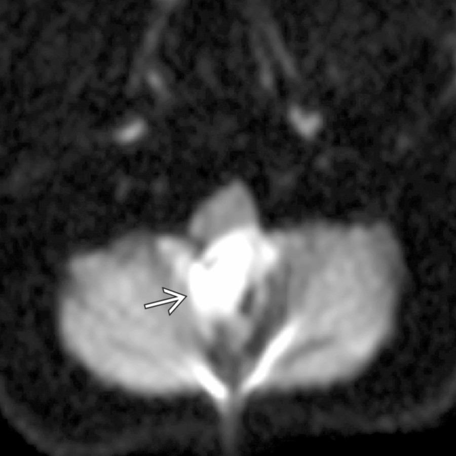 Axial DWI MR shows a hyperintense mass
in the midline posterior fossa.