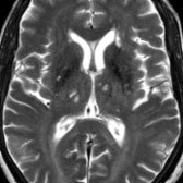 Axial T2 MR shows multiple T2-hyperintense lesions in the periventricular white matter
and thalami
due to remote lacunar infarcts. Lacunar infarcts in the deep gray nuclei are classically seen in patients with vascular dementia.