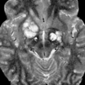 Axial T2 MR in a patient with HIV/AIDS shows several hyperintense cystic areas representing dilated perivascular spaces
from cryptococcosis. Fungi and gelatinous material collect within the spaces. There is typically little to no enhancement following contrast administration.