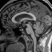 Sagittal T1WI MR in a 28-year-old woman being evaluated for seizures shows a well-delineated mass
that appears to lie within the 3rd ventricle, isointense to gray matter.