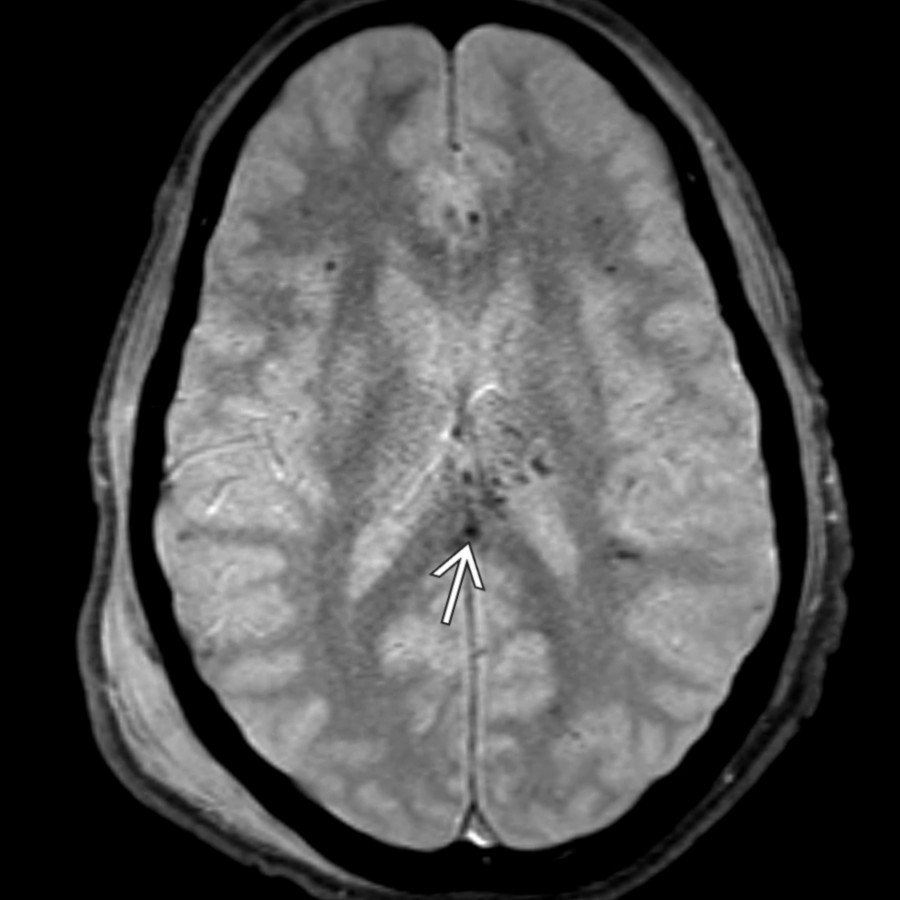 Axial GRE MR shows multiple punctate areas of susceptibility in the subcortical frontal white matter but also in the splenium of the corpus callosum
from diffuse axonal injury. Less well appreciated on this sequence are small lateral ventricles and cerebral edema.
