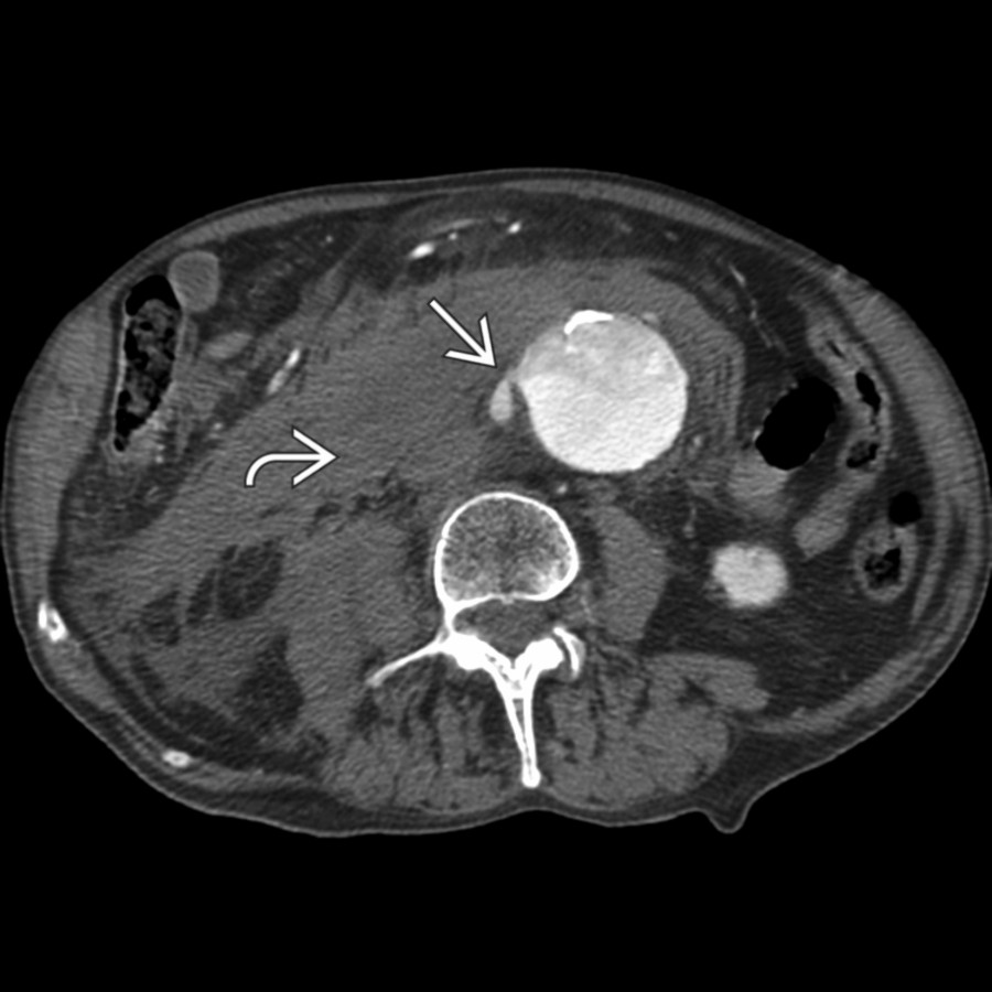 Coronal CECT shows extravasation of contrast
from a dilated abdominal aorta. Note extravasated blood
, which can easily be detected on unenhanced CT.
