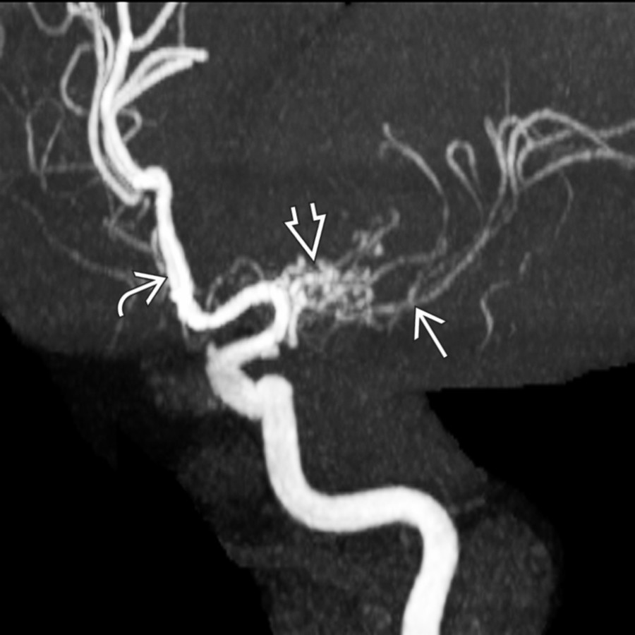 Oblique view of the left internal carotid MR angiogram shows a normal anterior cerebral artery (ACA)
, but the left MCA is severely attenuated
with reduced distal branches. A web of numerous small, tangled vessels
surrounds its M1 segment.