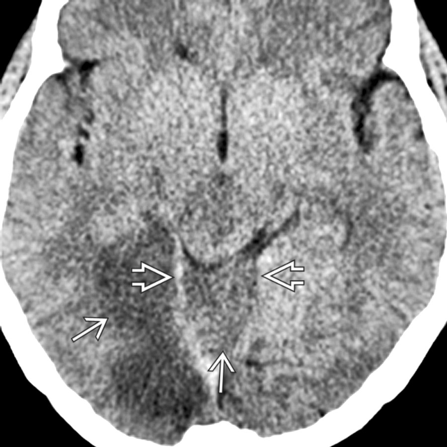 Axial NECT shows small ventricles and right occipital and vermian
low density due to infarct. Basal cisterns are effaced. Vermis is herniated upward through the tentorial incisura
, displacing midbrain anteriorly and superiorly.