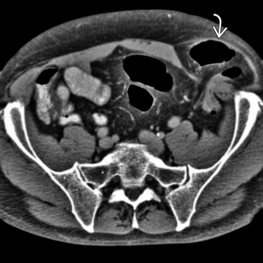 Axial CECT shows a Spigelian hernia
just lateral to the rectus muscle with an obstructed, herniated descending colon.
