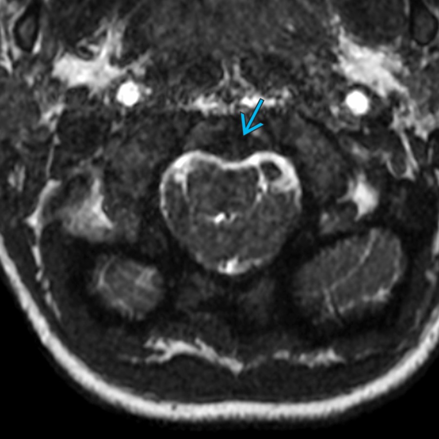 Axial FIESTA MR through the foramen magnum in the same patient demonstrates posterior displacement of the dens
with associated deformity of the ventral caudally displaced medulla. Partial effacement of the CSF spaces surrounding the cerebellar tonsils denotes moderate foramen magnum crowding.