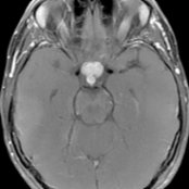 Axial T1 C+ MR shows intense, lobular enhancement in the suprasellar cistern and thickening of the pituitary stalk
in a patient with sarcoid. Neurosarcoid may involve any part of the CNS, including the meninges, cranial nerves, brain parenchyma, &/or the pituitary axis. Systemic disease is typically present.