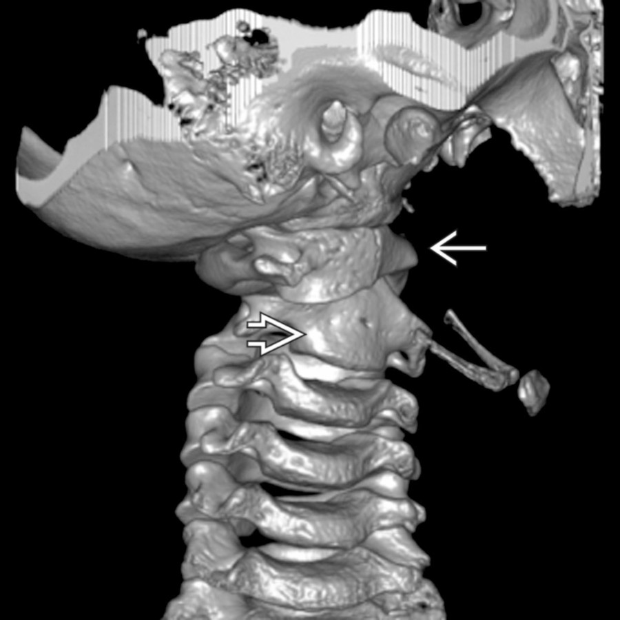 3D CT reconstruction visualizes the markedly left rotated C1
with respect to the mildly rotated C2
. Findings are typical of a Fielding-Hawkins type I atlantoaxial rotatory fixation.