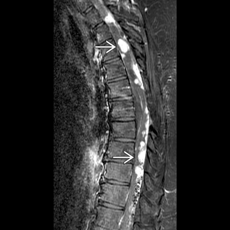 Sagittal T1 C+ FS MR shows multiple enhancing masses along and within the thoracic cord
in this patient with von Hippel-Lindau.