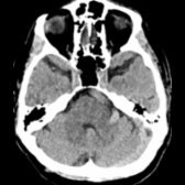 Axial CT shows fusiform dilatation and tortuosity of the basilar artery
in an octogenarian related to dolichoectasia. Fusiform dolichoectasia is a common finding in the vertebrobasilar arteries in older patients.