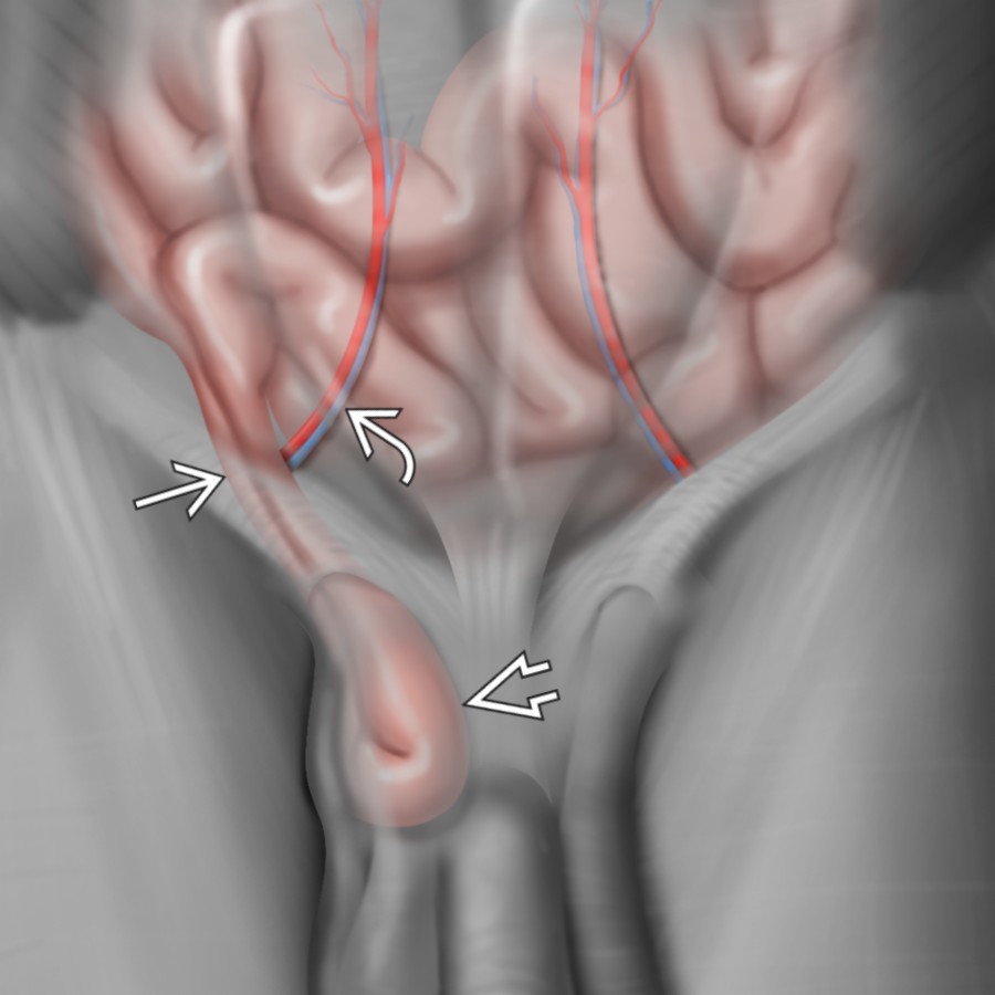 Graphic demonstrates an indirect inguinal hernia
with the hernia neck
located lateral to the inferior epigastric artery and vein
. The inferior epigastric vessels serve as the key landmark in distinguishing direct and indirect inguinal hernias.
