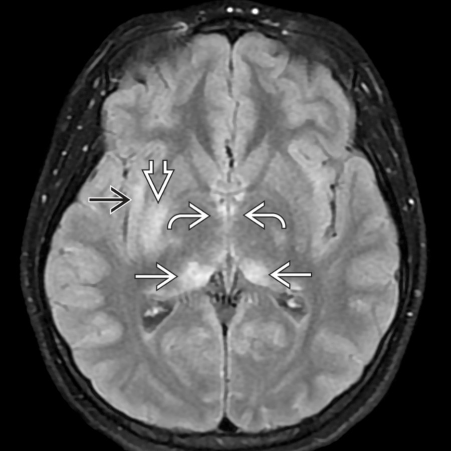 Axial FLAIR MR in a 10-year-old with acute myelin oligodendrocyte glycoprotein antibody-associated disease (MOGAD) shows characteristic thalamic
, basal ganglia
, hypothalamic
, and insular cortex
hyperintense lesions. The hypothalamic lesions are relatively subtle but correlated clinically with lethargy and hypothalamic symptoms and signs.