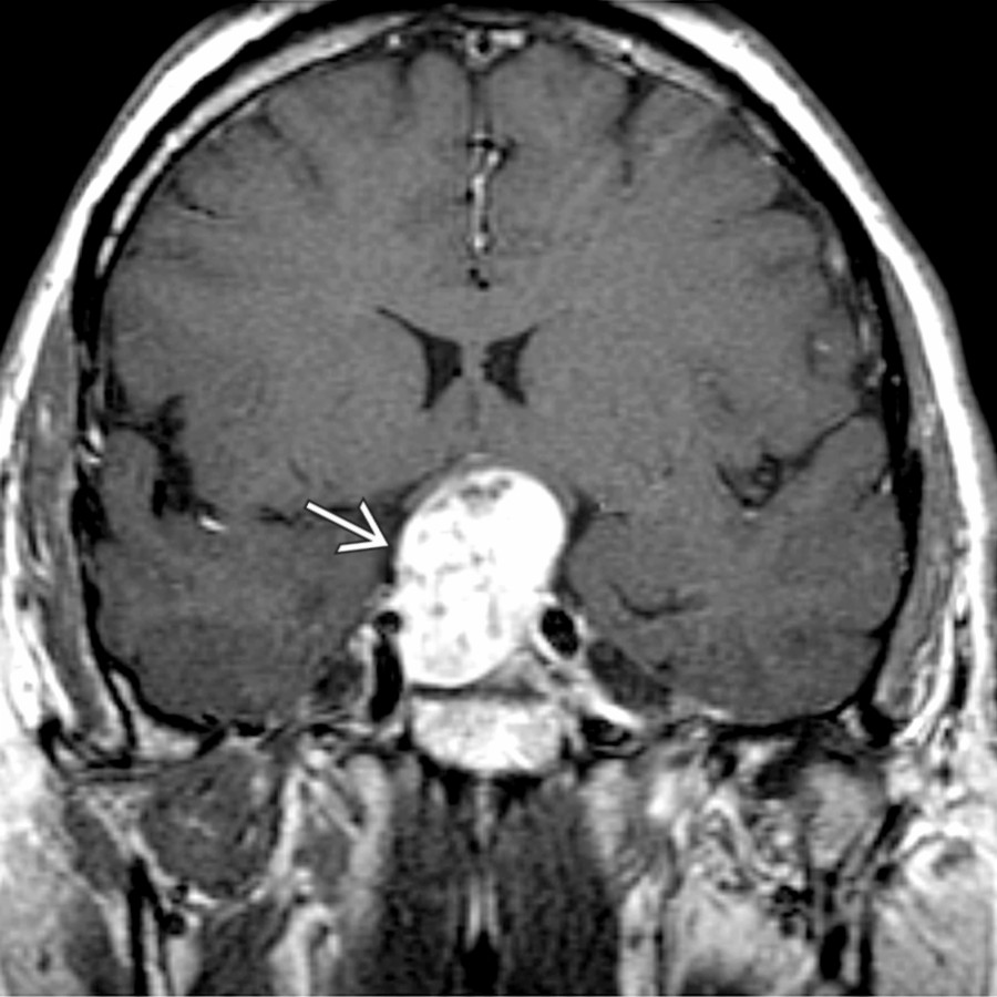 Coronal T1 C+ MR shows an inhomogeneously enhancing intra- and suprasellar mass
; the pituitary gland cannot be found separate from it and indeed is the mass.