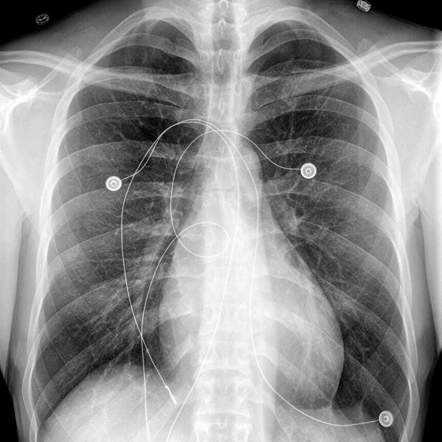 PA chest radiograph in a patient with MFS and acute aortic syndrome shows no specific cause of the symptoms reported in this individual. A normal radiograph does not exclude aortic dilatation or dissection.