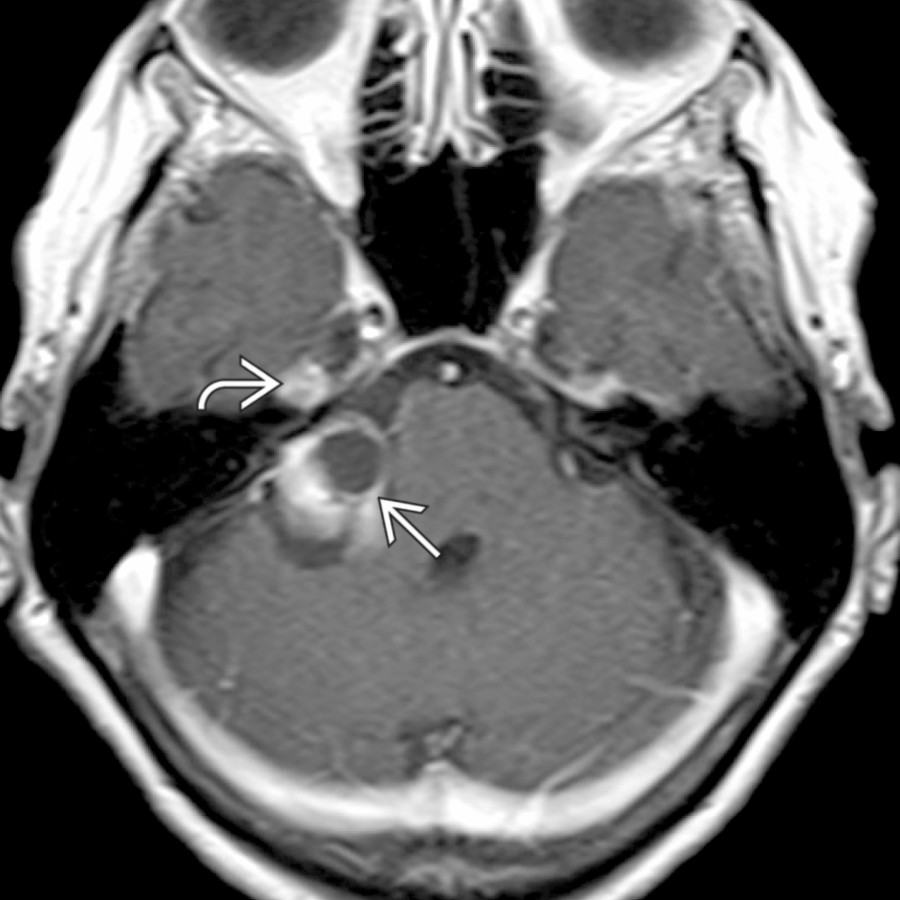 Axial T1 C+ MR shows a partly cystic, partly solid mass in the right CPA
and posterior Meckel cave
. Biopsy supported meningioma, which rarely may have cystic morphologies that mimic schwannoma.