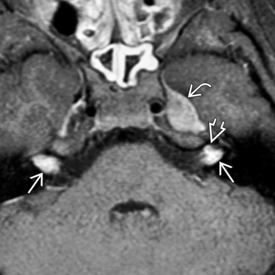 Axial C+ T1 FS MR in a patient with neurofibromatosis type 2 reveals bilateral enhancing vestibular schwannomas
in the IACs. Careful inspection shows the left IAC has a smaller, anterior facial nerve schwannoma
in addition. Notice also the left Meckel cave trigeminal schwannoma
.