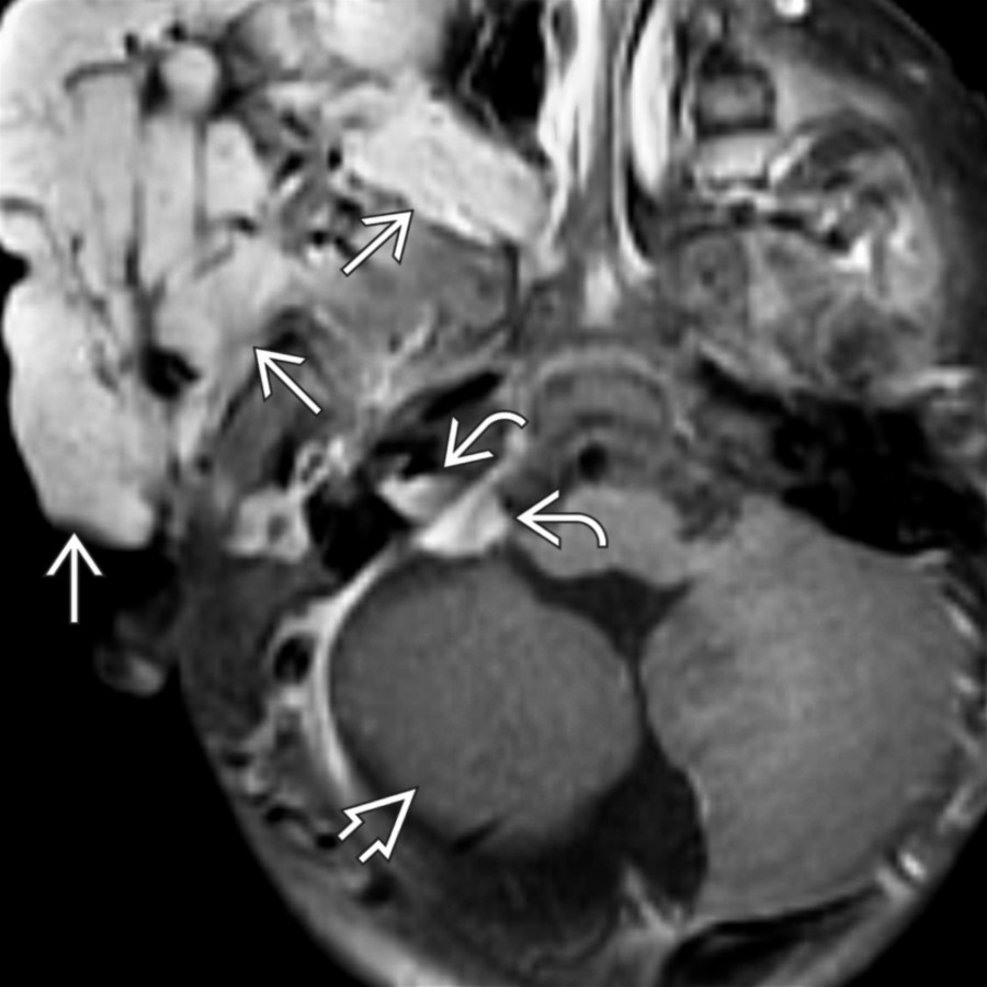 Axial T1 C+ MR in a 1-year-old infant shows a massive facial hemangioma
, a right CPA-IAC hemangioma
, and ipsilateral cerebellar hemisphere hypoplasia
. These findings are consistent with PHACE syndrome.
