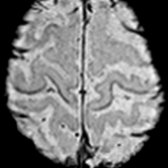 Axial SWI in same patient shows linear low signal along bilateral motor cortex
. EMG shows degeneration and chronic reinnervation in a multisegmental distribution, consistent with motor neuron disease.