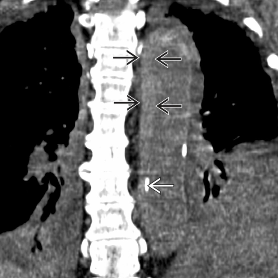 Coronal NECT shows asymmetric thickening and hyperdense
aortic wall, representing the hematoma. Note the displaced intimal calcification
.