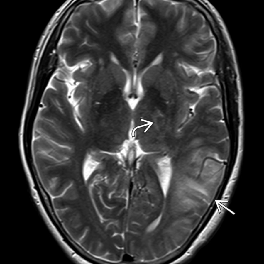 Axial T2 MR in the same patient shows gyral swelling, sulcal effacement, and hyperintensity in the left temporal and parietooccipital cortex/subcortical white matter
, basal ganglia
. DWI (not shown) was normal. This is a classic example of postcarotid endarterectomy hyperperfusion syndrome.