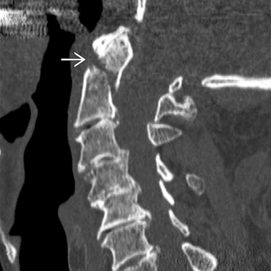 Sagittal NECT shows a type 2 dens fracture
in an osteoporotic patient. Soft tissue swelling is mild. These fractures are commonly subtle on radiographs and best seen on lateral (not odontoid) view. If there is any question, perform CT.