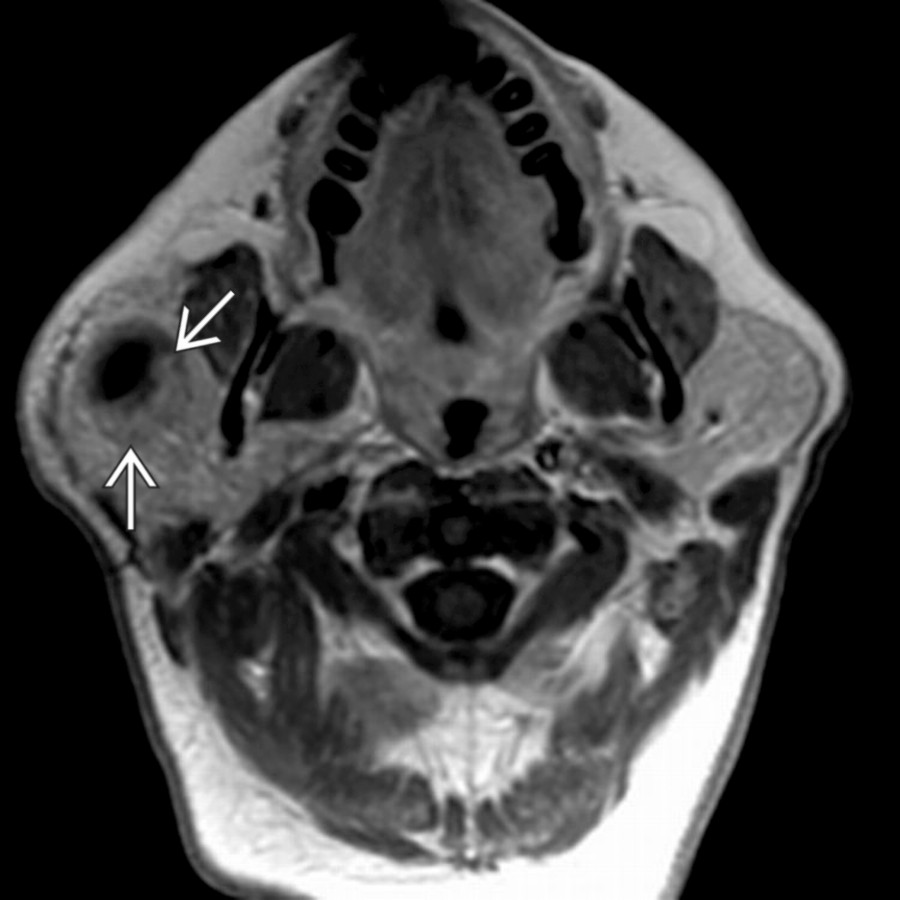 Axial T1 C+ MR shows a mass
with enhancement that allows it to blend into the surrounding high-intensity parotid fat. Fat-saturated images are useful to distinguish intraparotid schwannomas after contrast has been administered.