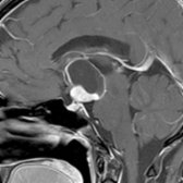 Sagittal T1 C+ MR in a 45-year-old woman shows a cystic and solid mass with an enhancing portion
, which distinguishes this cystic lesion as a craniopharyngioma, not a Rathke cleft cyst. Surgical resection is the primary therapy for this WHO grade 1 neoplasm. However, the recurrence rate at 10 years approaches 20%.