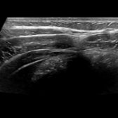 High-resolution transverse grayscale ultrasound at the right anterolateral abdominal wall shows the relationship of the lateral abdominal wall muscles in better detail. Note the oblique and transversus abdominis muscles taper medially as they become aponeuroses.