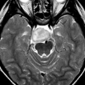 Axial T2WI MR in the same patient shows the mass is heterogeneously hyperintense compared to cortex. HHs can be huge, measuring up to several cm in diameter. A mass of dysplastic, disorganized gray matter was removed at surgery and was consistent with HH.