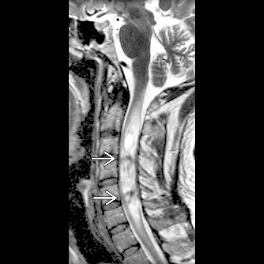 Sagittal T2 MR shows a complex cervical cord mass containing foci of susceptibility
, demonstrating prior hemorrhage within an ependymoma.