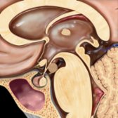 Sagittal graphic shows a classic pedunculated tuber cinereum hamartoma
interposed between the infundibulum anteriorly and the mammillary bodies posteriorly. The mass resembles gray matter.
