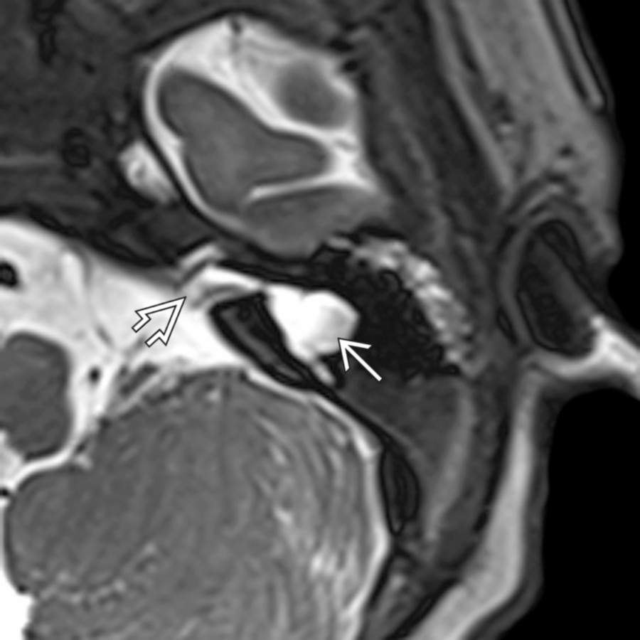 Axial 3D T2 SPACE MR in a child with SNHL shows cochlear aplasia, a globular vestibule, and a horizontal SCC
. There is a narrow, malformed IAC
with a vestibular nerve noted posteriorly.