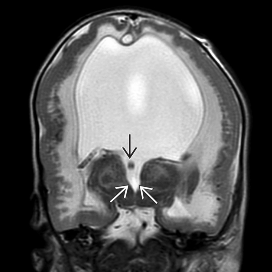 Coronal T2WI MR in the same patient confirms marked ventriculomegaly, funnel-shaped cerebral aqueductal stenosis
, fused fornices
, and classic cobblestone lissencephaly.